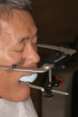 総入れ歯(フルデンチャー)05