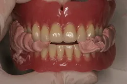 総入れ歯(フルデンチャー)07