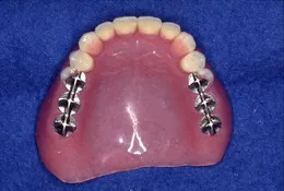 総入れ歯(フルデンチャー)08