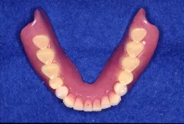 総入れ歯(フルデンチャー)10