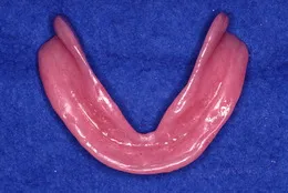 総入れ歯(フルデンチャー)11