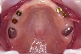 オーバーデンチャー01