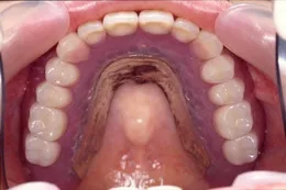 オーバーデンチャー02