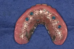 オーバーデンチャー04