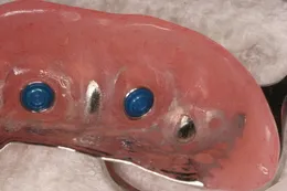 オーバーデンチャー05