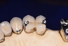 部分入れ歯(パーシャルデンチャー)04