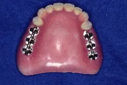 総入れ歯(フルデンチャー)01