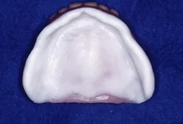 総入れ歯(フルデンチャー)02