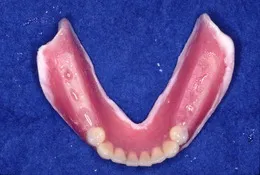 総入れ歯(フルデンチャー)03