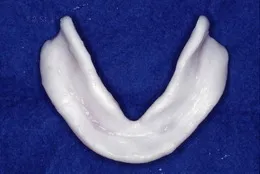 総入れ歯(フルデンチャー)04