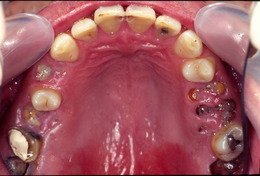 部分入れ歯の症例 Before