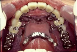 治療後の口腔内写真