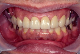 部分入れ歯の症例 After
