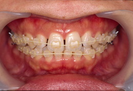 矯正歯科治療症例 Before