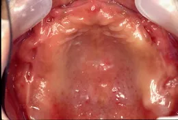 無歯顎インプラント症例(フルマウス症例) Before