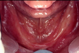 インプラントを活用した総義歯の症例 Before