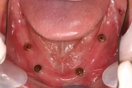 インプラントを埋入した口腔内画像