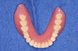 インプラントを活用した総義歯の症例 After