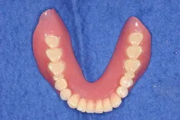 インプラントを活用した総義歯の症例 After