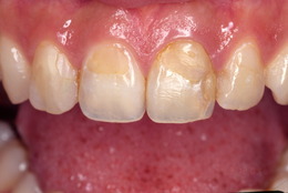 前歯部の審美歯科症例　CaseⅠ Before