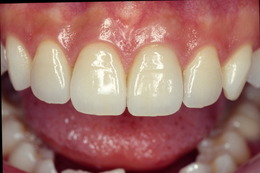 前歯部の審美歯科症例　CaseⅠ After