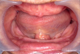 総義歯（入れ歯）の症例 Before