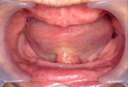 総義歯(入れ歯)の症例 Before