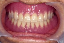 総義歯（入れ歯）の症例 After