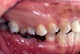 臼歯部のインプラント症例　CaseⅠ Before