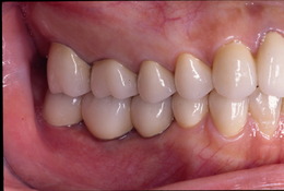 臼歯部のインプラント症例　CaseⅠ After