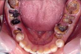 臼歯部のインプラント症例　CaseⅡ Before