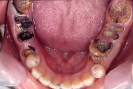 臼歯部のインプラント症例 CaseⅡ Before