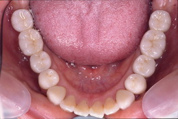 臼歯部のインプラント症例　CaseⅡ After