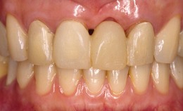 前歯部の審美歯科症例　CaseⅡ Before