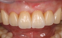前歯部の審美歯科症例　CaseⅡ After