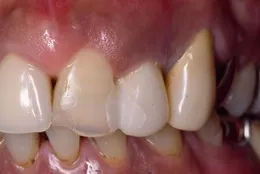 インプラント症例 Before